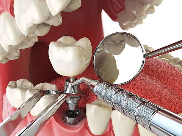 Best Emergency Dental Care for Abscessed Tooth in Denton, TX